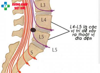 Thoát vị đĩa đệm l5 s1 - Nguyên nhân, triệu chứng và cách điều trị