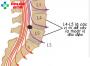 Thoát vị đĩa đệm l5 s1 - Nguyên nhân, triệu chứng và cách điều trị